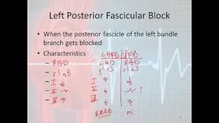 12 Lead Interpretation Part 42 Bundle Branch and Fascicular Blocks [upl. by Mcquillin]