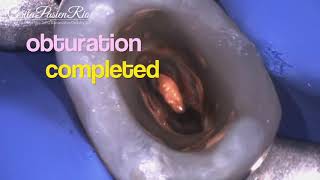 My endodontic Jouney perawatan saluran akar leakage of arsenic contained paste [upl. by Robison595]