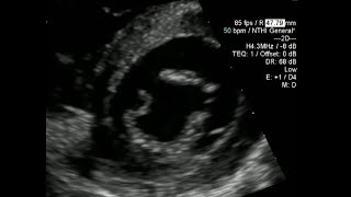 AV Canal Defect with a Gerbode Type VSD and Cleft Mitral Valve [upl. by Eisen718]