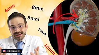 Expelir Cálculo Renal Sem Cirurgia É Possível [upl. by Elson]