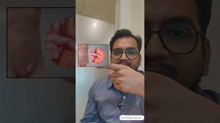 Inguinal Hernia Swelling I Laparoscopic Hernia treatment in Delhi Noida [upl. by Housen]