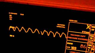 Low oxygen saturation [upl. by Inafetse66]