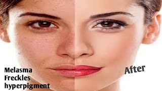 NUVEL CreamMelasma CreamFrecklesDark ComplexionUneven skinin Urdu in Hindi [upl. by Innek]