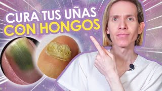 COMO CURAR LOS HONGOS EN LAS UÑAS  Guía para resolver Onicomicosis de manos y pies  Simon Scarano [upl. by Nonnahsed]