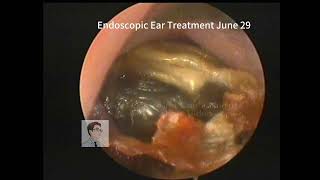 Re examination of Cholesteatoma 20230629 [upl. by Beberg]