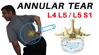 Annular Tear L4L5 L5S1 Disc Bulges [upl. by Adna269]