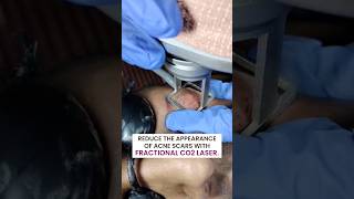 Fractional CO2 Laser Treatment at Reincarnation Skin Clinic [upl. by Brittnee]