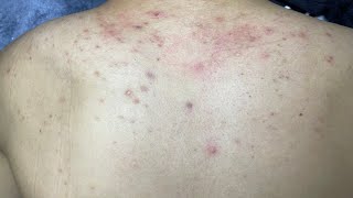 ACNE TREATMENT VU QUYNH MI  Acne On Back FULL [upl. by Yasnyl]