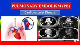 PULMONARY EMBOLISM PE  Definition types causes pathophysiology signs amp symptoms medicine [upl. by Cosmo]