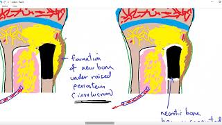 Systemic pathology 34  bone 4  osteomyelitis  DRSAMEH GHAZY [upl. by Emearg]