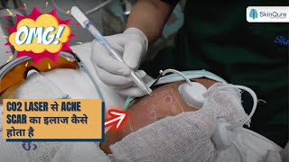 CO2 Laser for Acne Scar Removal  Explained by Dr Jangid  SkinQure  Dr Jangid [upl. by Einalem311]