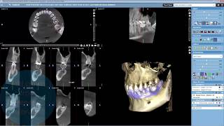 Planmeca Romexis 3D Implant Planning with open STL and crown library [upl. by Airotciv]