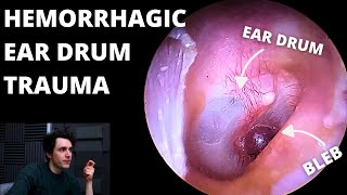 Blood Sac Found On Eardrum Hearing Loss amp Tinnitus [upl. by Shelman24]