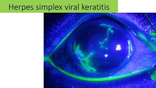 Herpes simplex keratitis  causes sign clinical pictures and management [upl. by Anauqed]