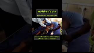 Brudzinskis sign a physical exam to test meningitis [upl. by Goode]