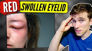 Swollen Eyelid causes amp solutions  Eye Doctor Explains [upl. by Kaplan330]