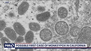 Monkeypox case possibly detected in California [upl. by Majka]