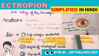 Ectropion  Hindi  Opthalmology [upl. by Prosper]