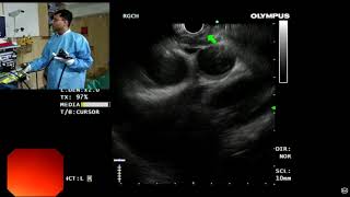 EUS Anatomy of mediastinum [upl. by Ylek]