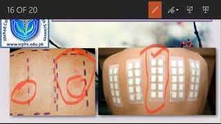 Patch test  intradermal test Diagnosis of Allergy Part2 [upl. by Rowena931]