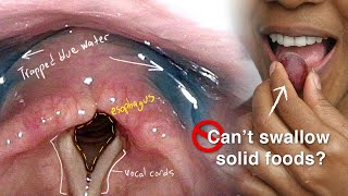 Cricopharyngeal Dysfunction Difficulty Swallowing Especially Solid Foods [upl. by Carberry]