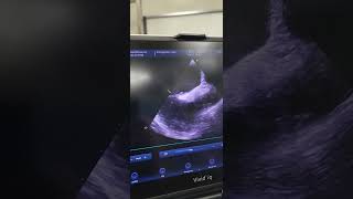 Echocardiography finding of elderly patient with asdpfo [upl. by Sergeant]