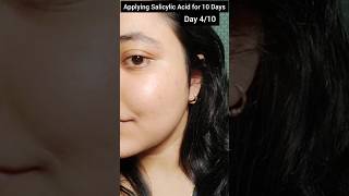 Day 4 of Applying Salicylic Acid for 10 days the dermaco salicylic acid serum skincarebeautylove [upl. by Onaicnop]