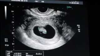 8 Weeks Ultrasound [upl. by Isla]