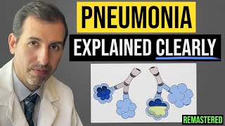 Pneumonia Explained Symptoms Diagnosis Labs Treatment [upl. by Leivad]