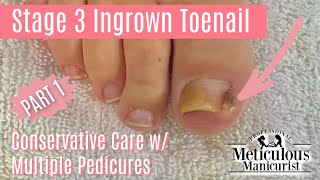 How to Trim Nails with Ingrown Toenail Discomfort and Deep Nail Grooves [upl. by Nevins]