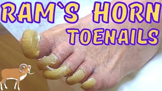 Rams horn Super long toenails painless trimming Onychogryphosis [upl. by Elyrad]