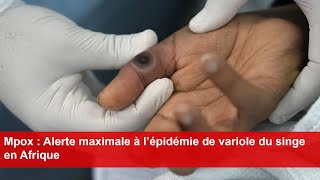 Mpox  Alerte maximale à l’épidémie de variole du singe en Afrique [upl. by Oidiple]