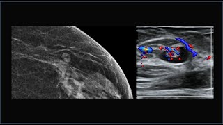 Achados mamográficos e ecográficos típicos dos linfonodos intramamários [upl. by Euqenimod]