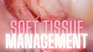 Soft Tissue Management During Extractions  OnlineExodontiacom [upl. by Ivette900]