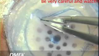 DMEK tissue preparation Principles and tips Tarek Katamish [upl. by Nyliuqcaj]