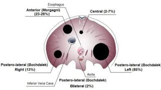 Defects of the Diaphragm Foramen morgagni Hernia Foramen Bockdalek Hernia [upl. by Euqinomad]