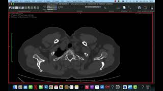 ANATOMIA NA TOMOGRAFIA DE TÓRAX [upl. by Doss778]