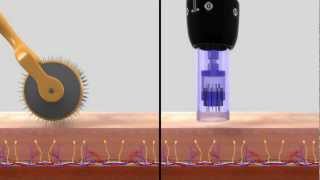 DERMAPEN SISTEMA DE REMODELACIÓN TISULAR [upl. by Inahteb]