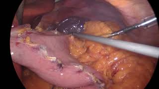 adhesions post open cholecystectomy How I approach to do Gastric Sleeve [upl. by Kimmi]