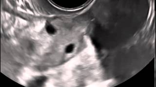 Ultrasound in Obstetrics amp Gynecology A Practical Approach  Clip 123 [upl. by Nimesh]