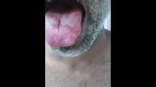 Geographic tongue [upl. by Cleti]