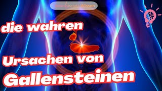 Gallensteine  das solltest Du wissen [upl. by Ahgem]