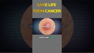 Symptoms of Lumps Cancer  Oral Cancer  Digestive System Cancer [upl. by Diella]