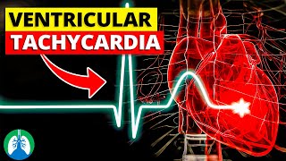 Ventricular Tachycardia Vtach  Medical Explainer Video [upl. by Alyac]