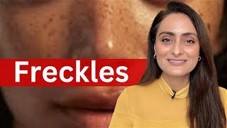 Freckles  causes  treatment  recommendations  Dermatologist [upl. by Alleirbag]