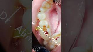 Single Visit Endodontic Treatment الكربولة endodontics dental [upl. by Maurise]