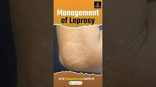 Management of Leprosy  Treatment Prevention Leprosy management treatment shortvideo nursing [upl. by Yolande]