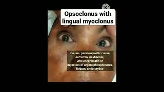 Opsoclonus with lingual myoclonus [upl. by Sisto]