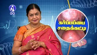 ADENOMYOSIS  GG HOSPITAL  Dr KAMALA SELVARAJ [upl. by Ynolem]