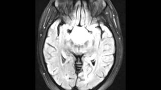 Adamantinomatous Craniopharyngioma [upl. by Becht]